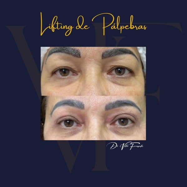 Lifting de Pálpebras