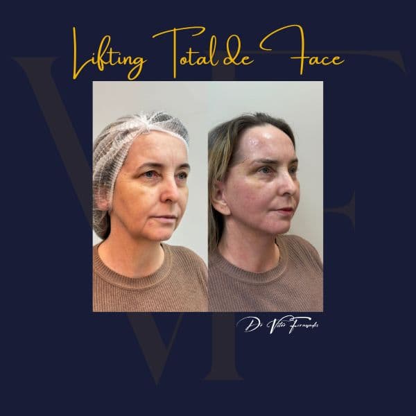 Lifting Total de Face