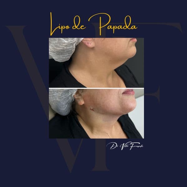 Lipo de Papada