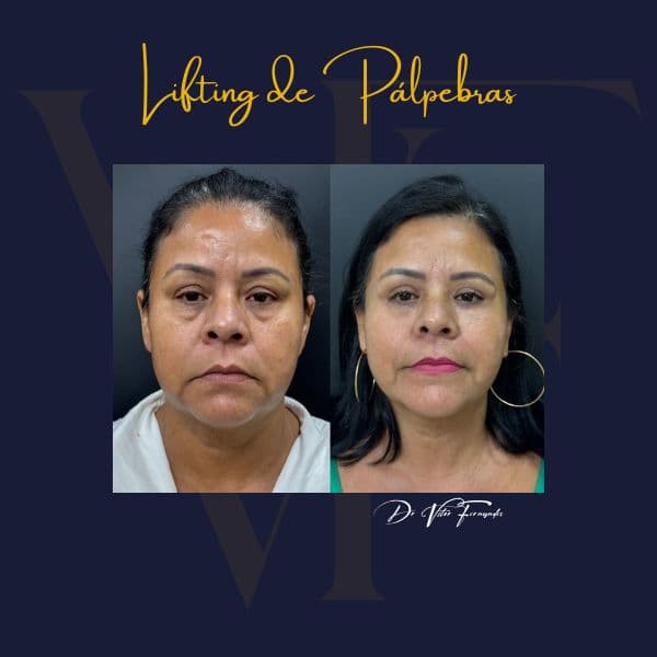 Lifting de Pálpebras
