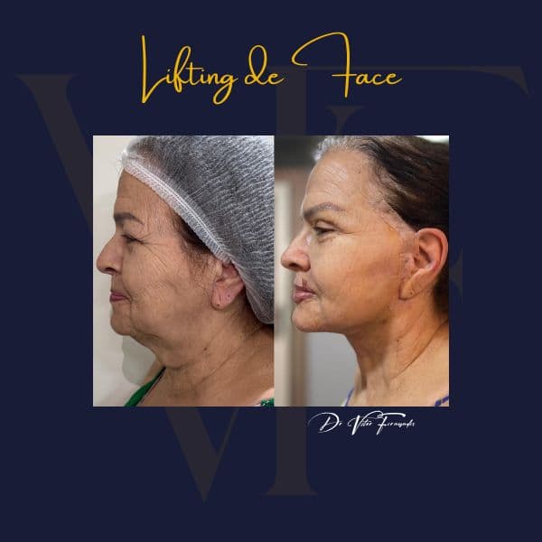 Lifting de Face