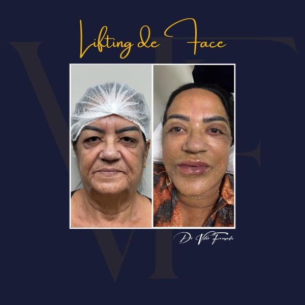 Lifting de Face