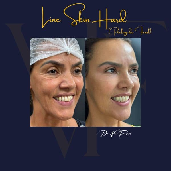 Line Skin Hard — Peeling de Fenol