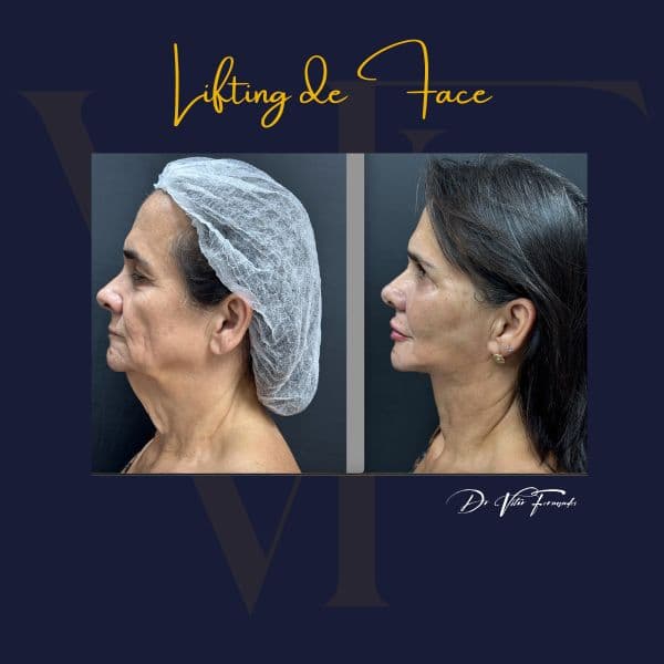 Lifting de Face