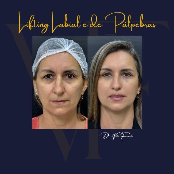 Lifting Labial e de Pálpebras