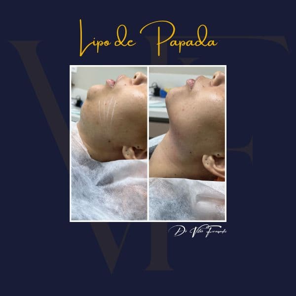 Lipo de Papada