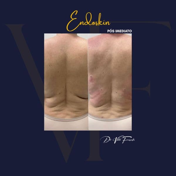 Endoskin