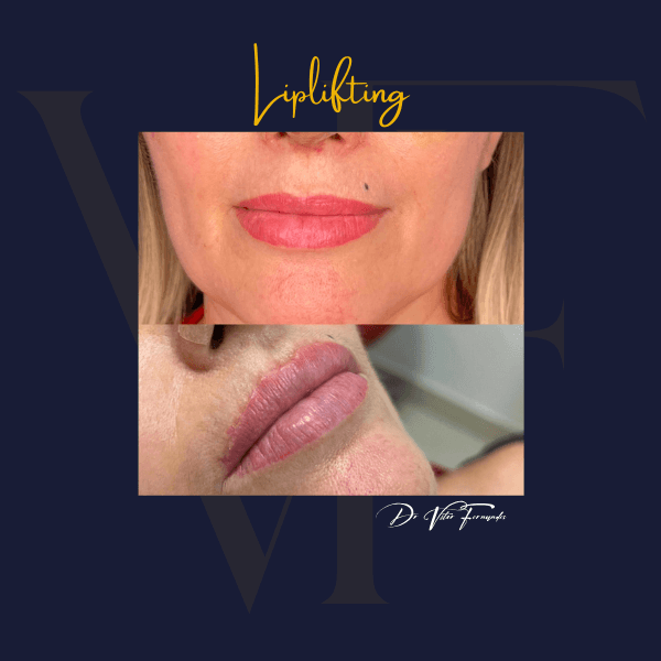 Liplifting