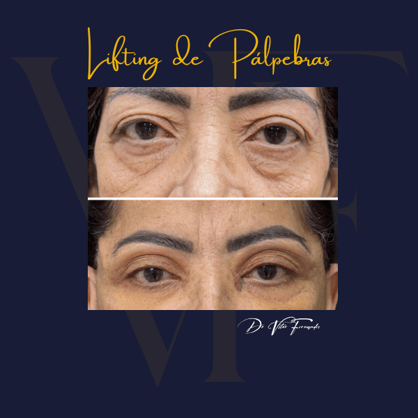 Lifting de Pálpebras