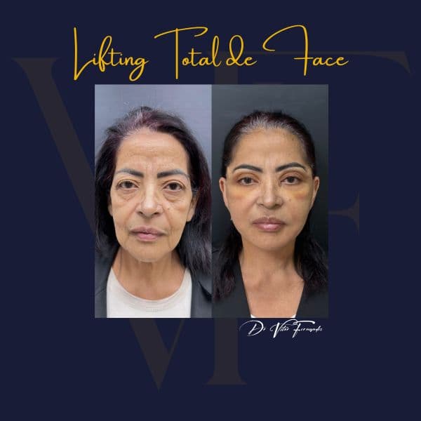 Lifting Total de Face