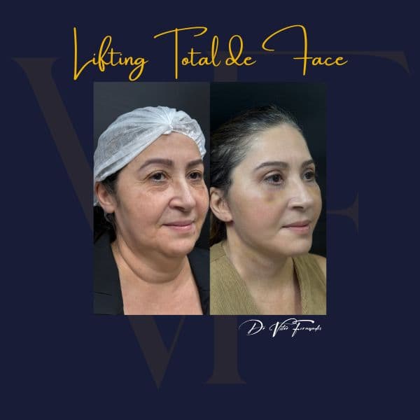 Lifting Total de Face