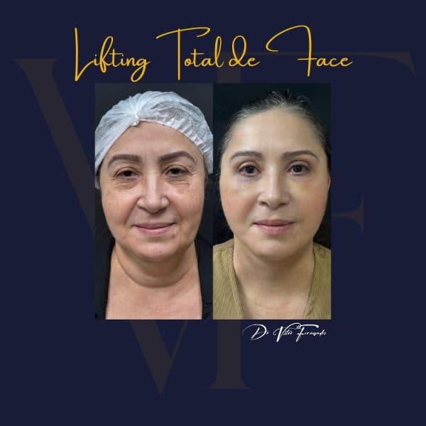Lifting Total de Face