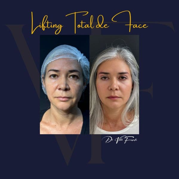 Lifting Total de Face