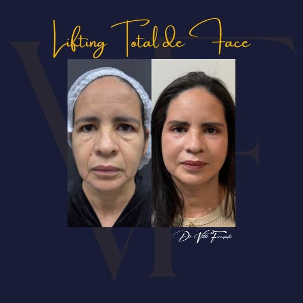 Lifting Total de Face