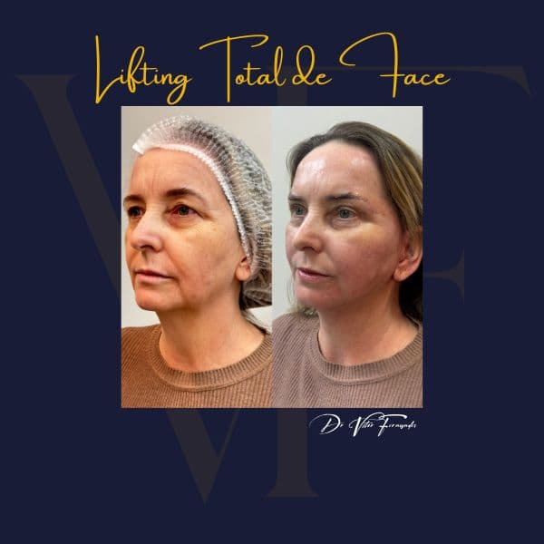 Lifting Total de Face