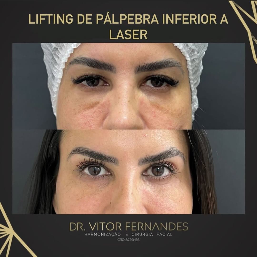 Lifting de Pálpebra Inferior