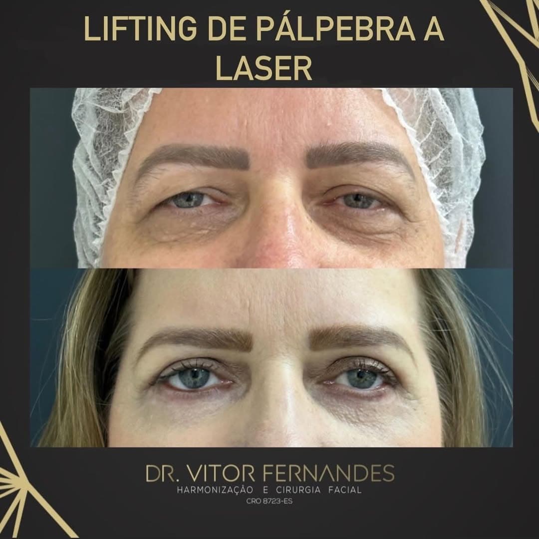 Lifting de Pálpebra a Laser