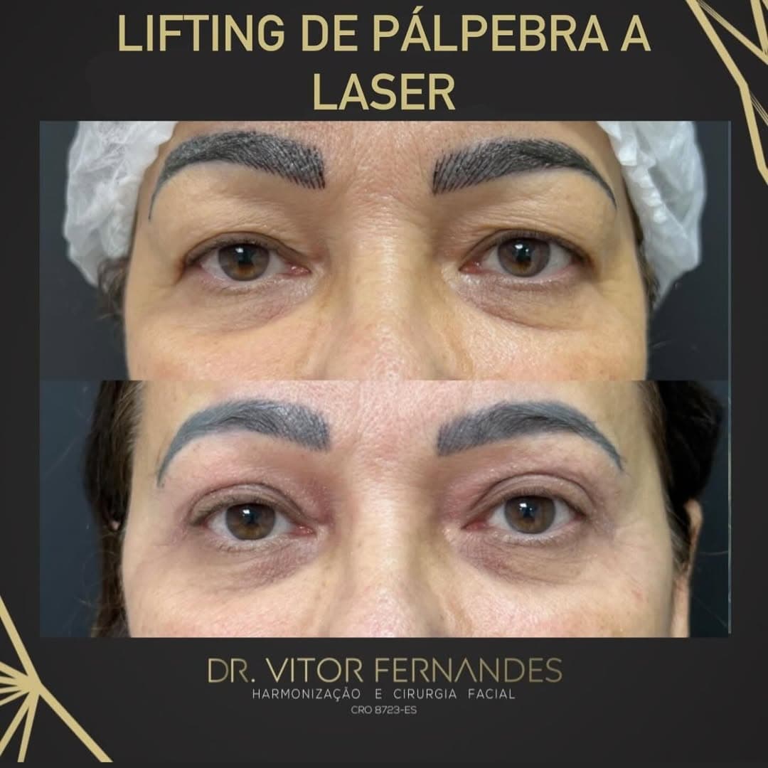 Lifting de Pálpebra a Laser