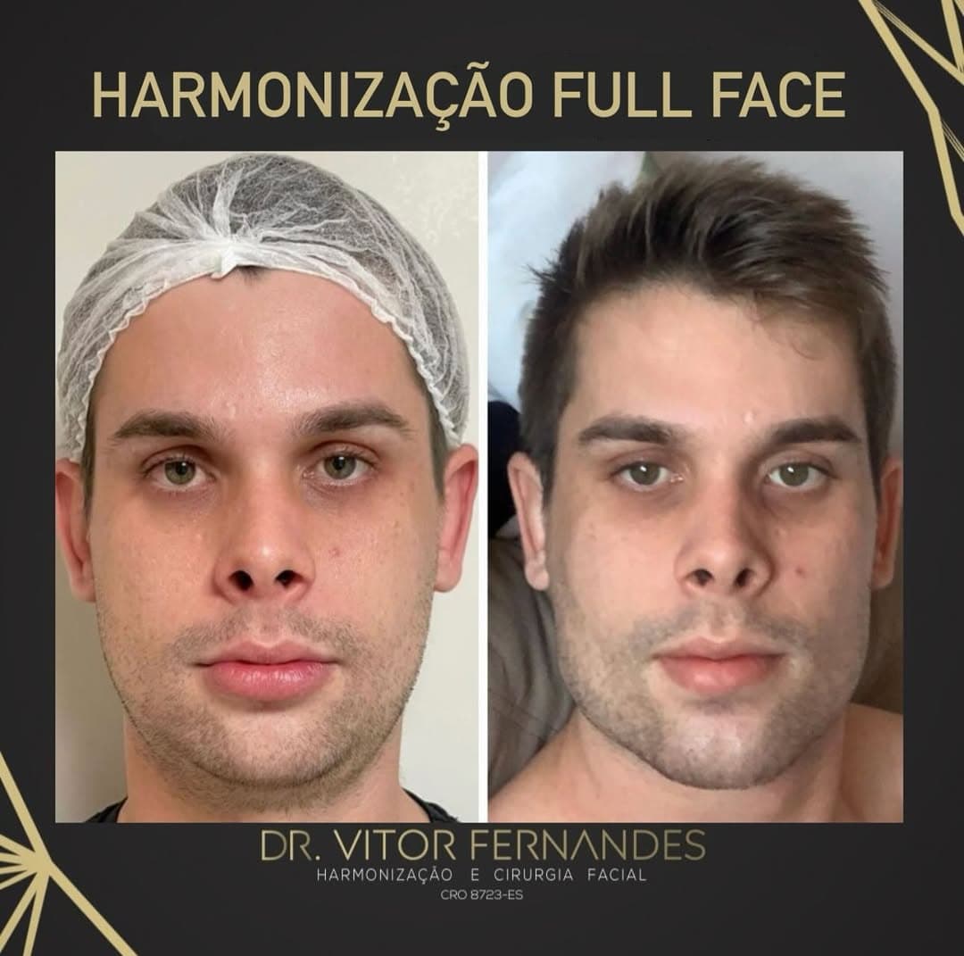 Harmonização Full Face
