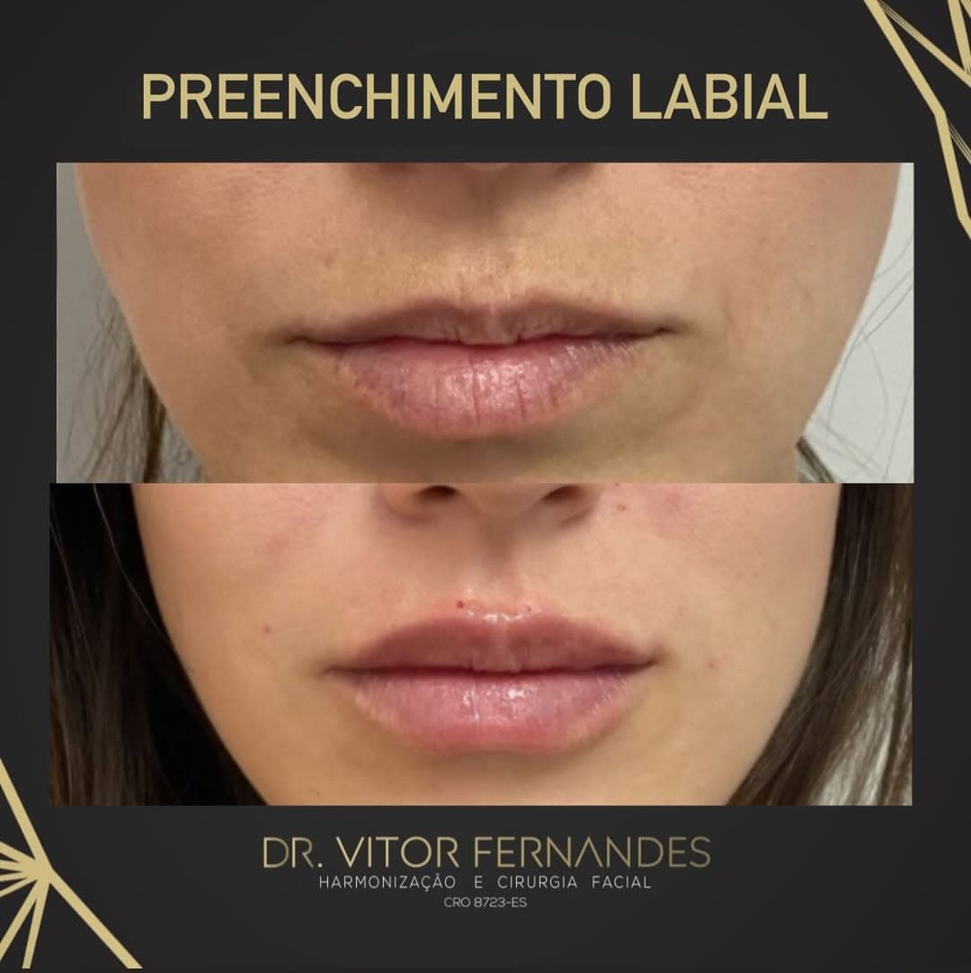 Preenchimento Labial
