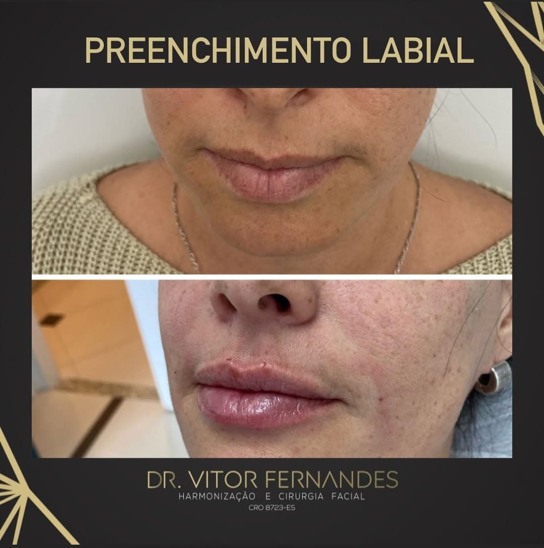 Preenchimento Labial