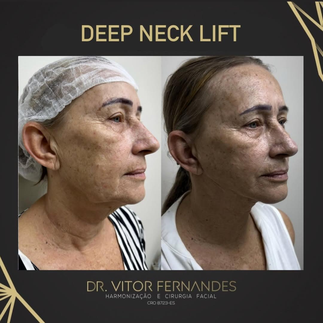 Deep Neck Lift