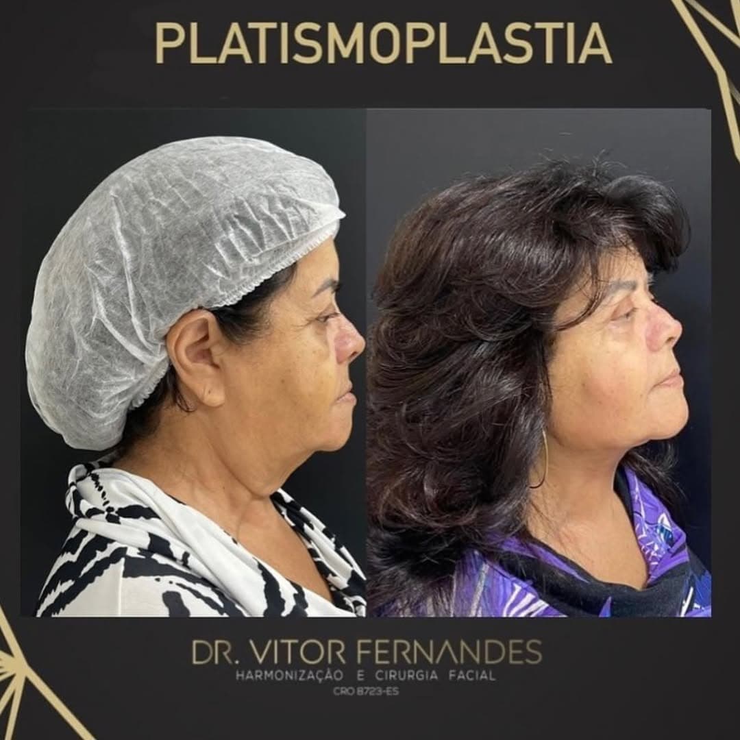 Platismoplastia