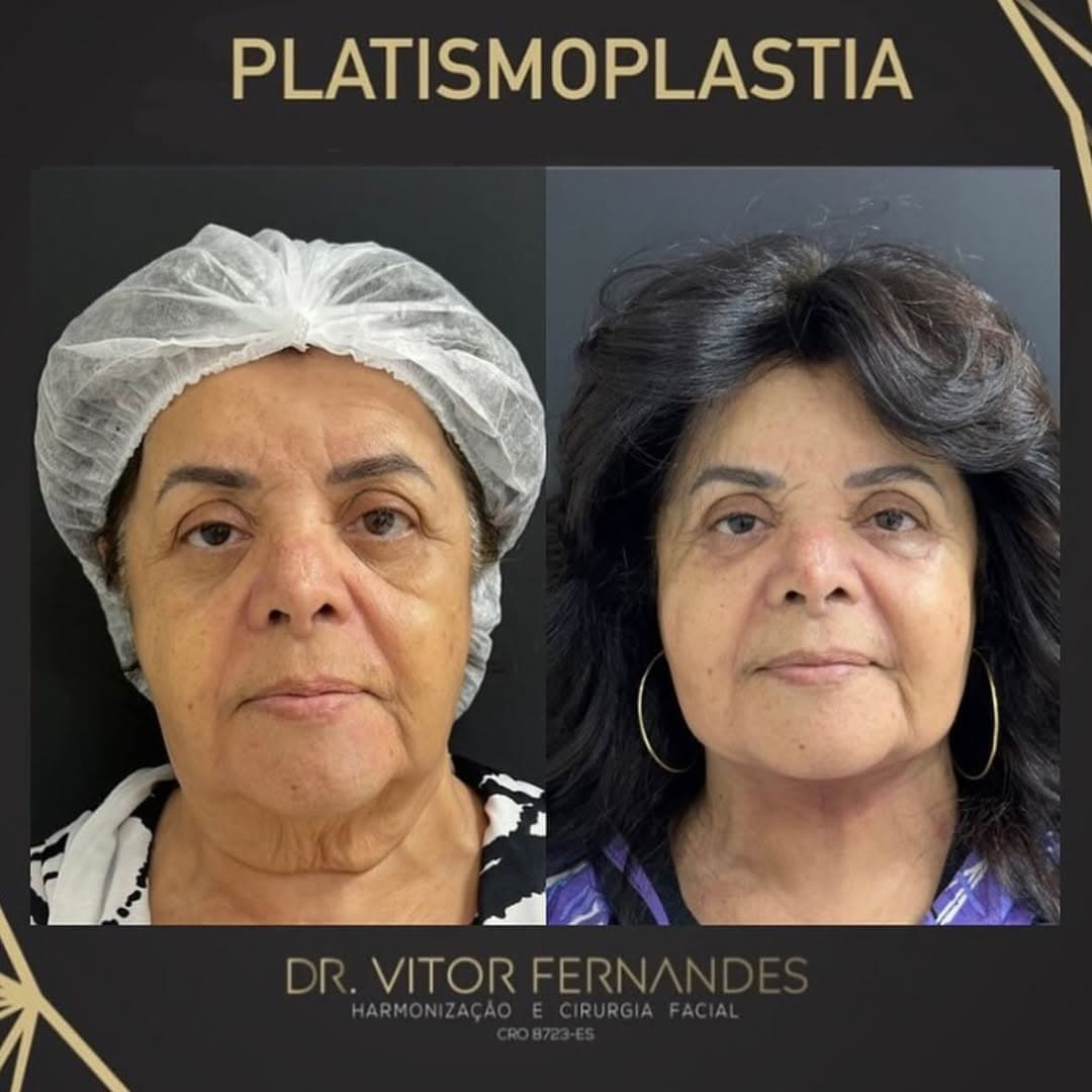 Platismoplastia