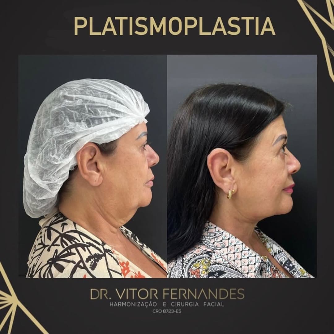 Platismoplastia